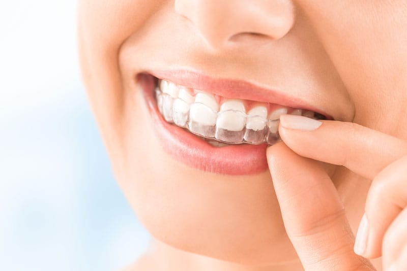 A close-up of a smiling person inserting an Invisalign® clear aligner over their teeth, showcasing a popular alternative to traditional braces for orthodontic treatment.