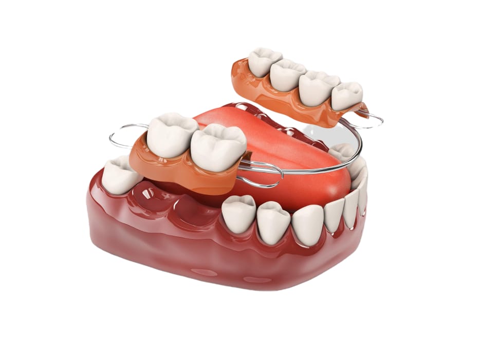 A 3D-rendered model of a lower jaw showcasing partial dentures with metal clasps and artificial teeth, demonstrating a common dental solution for missing teeth.