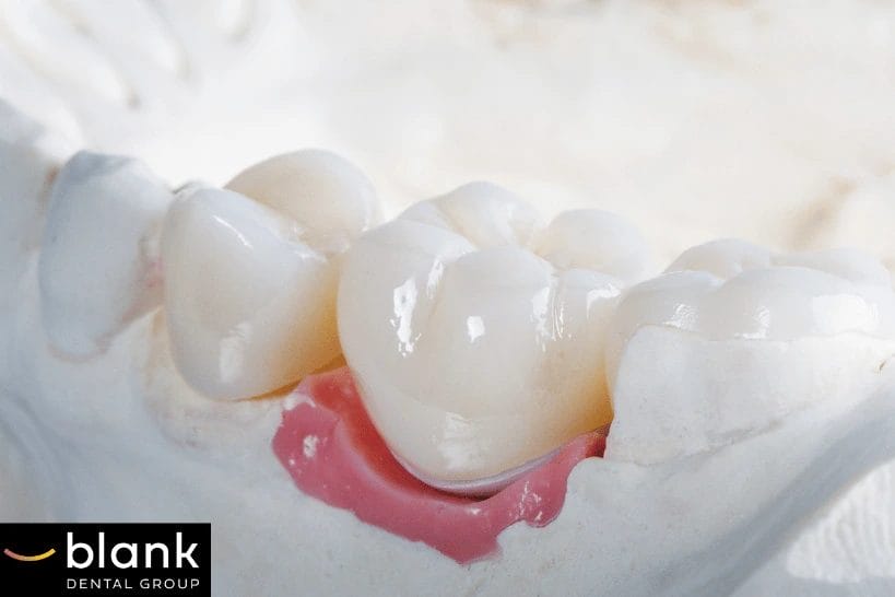 Model of a dental crown on a white background